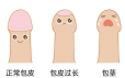 包皮过长不重视，这些后果可能会迎面而来