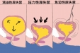 男性尿失禁是怎么引起的？主要与这6大诱因有关