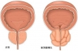 “前列腺增生”到什么程度需要手术？