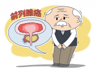 早期前列腺癌常无症状！这些细微信号别放过