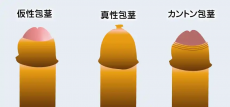 包茎不同类型症状不同，快看看你属于哪个类型？