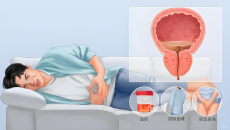 前列腺增生怎么办？这6个早期信号千万别忽视