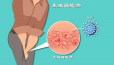 男性生殖器疱疹能治愈吗？治疗期间牢记这3点恢复得快！
