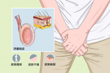 阴囊湿疹的3种症状要小心，应做好正确护理！
