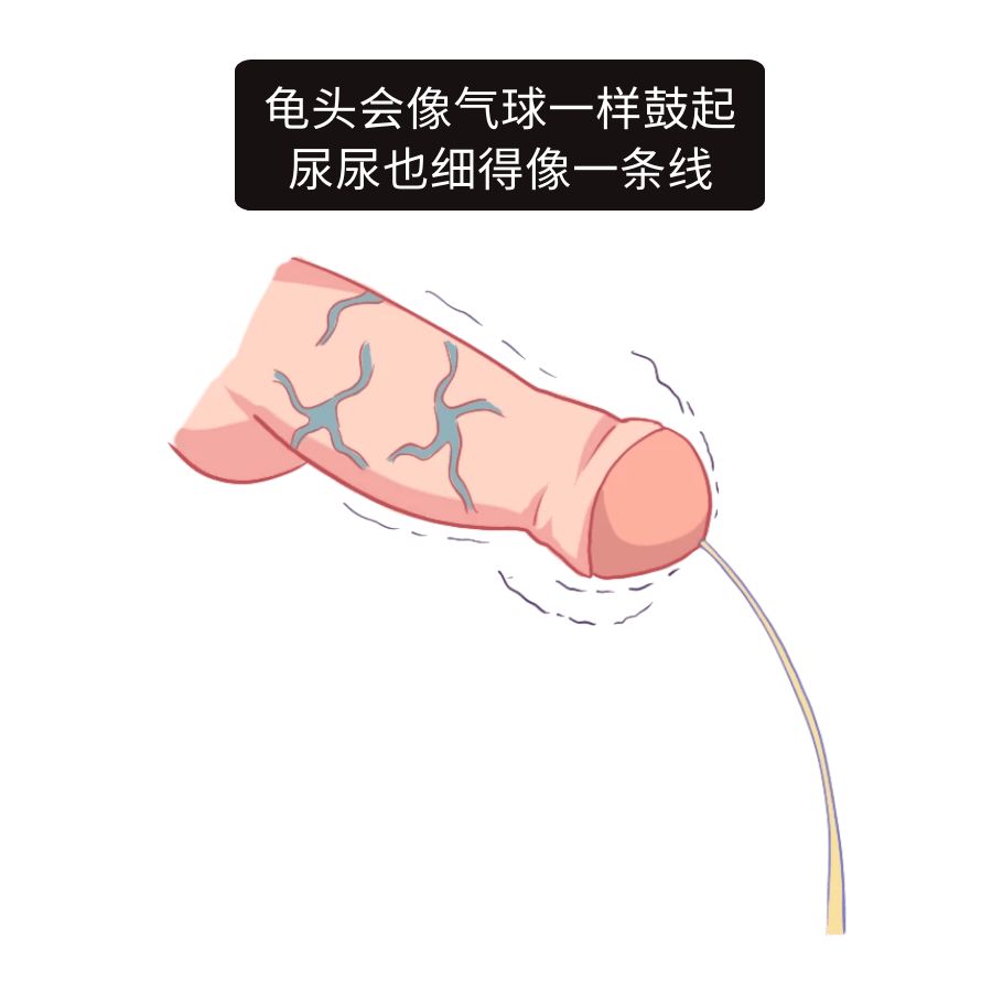 包皮龟头炎