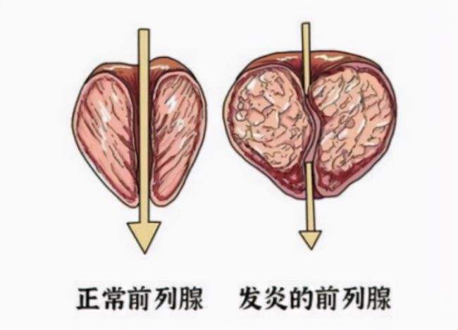 前列腺炎