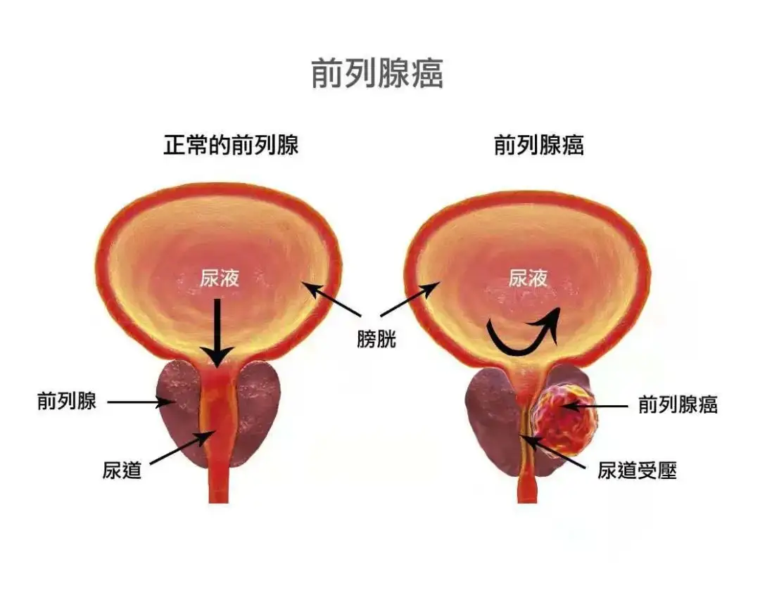 前列腺癌