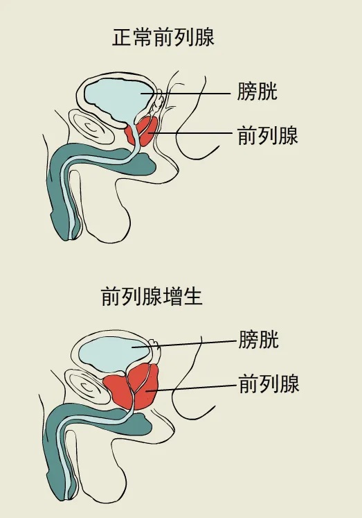 前列腺增生