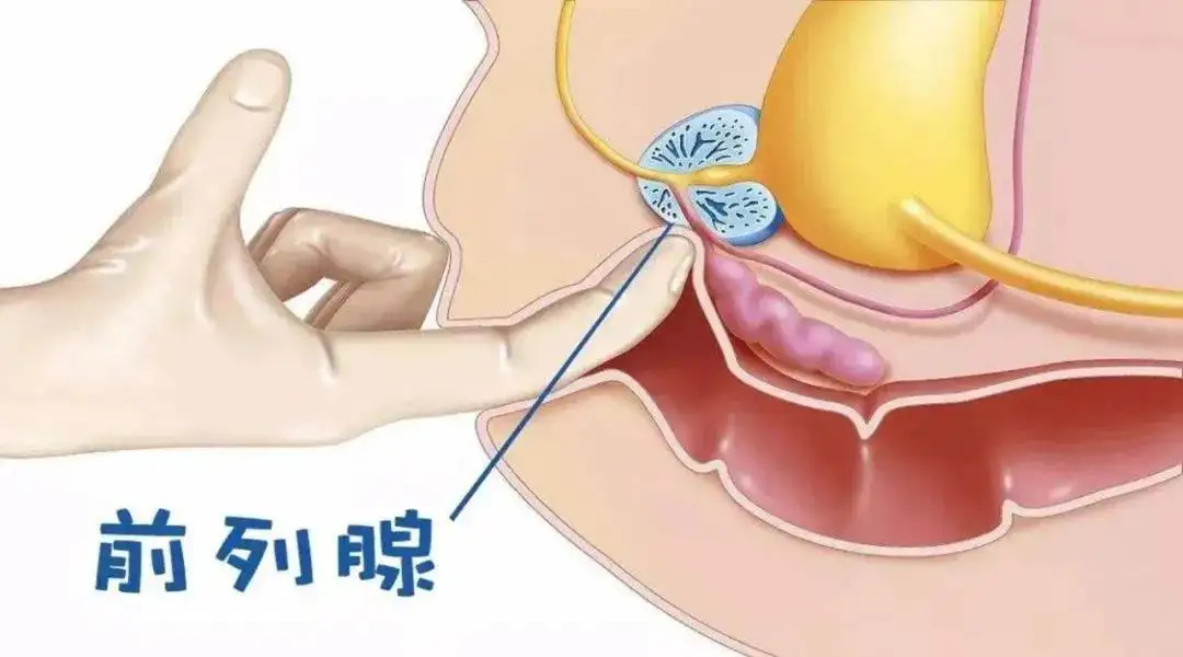 前列腺按摩