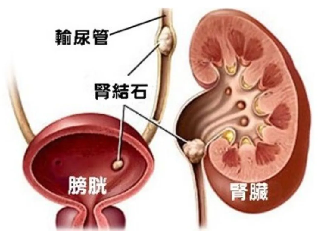 肾结石或输尿管结石