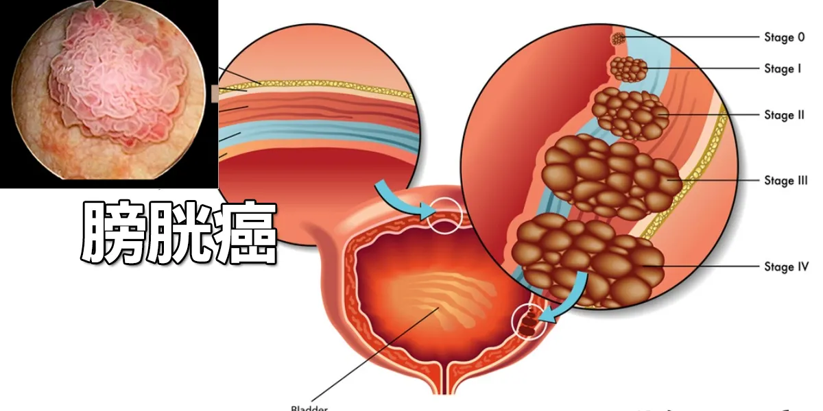 膀胱癌
