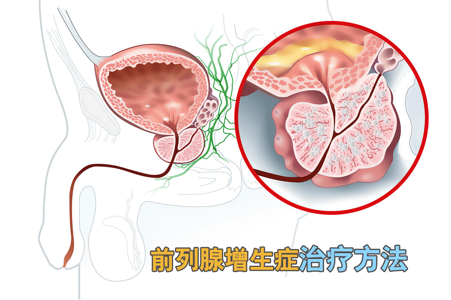 前列腺增生治疗