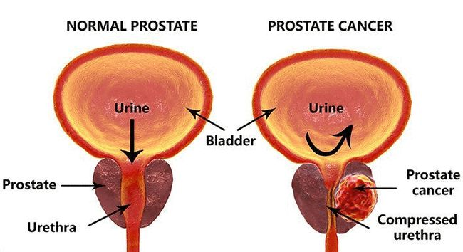 前列腺癌与男性勃起功能障碍