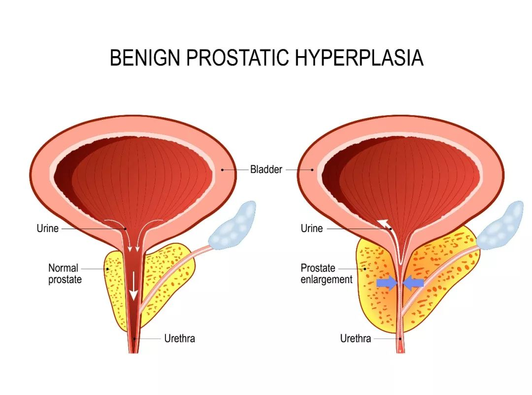 下尿路综合征(LUTS)和前列腺良性增生(BPH)症与男性勃起功能障碍