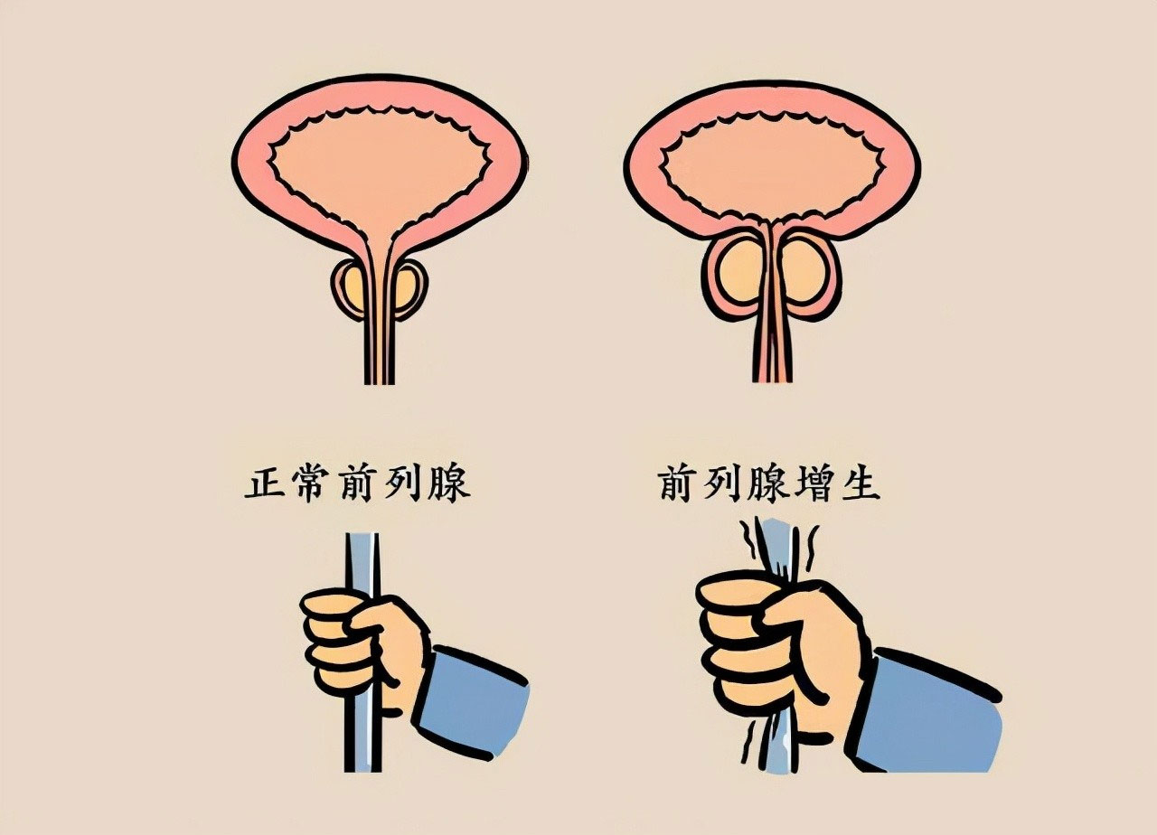 前列腺增生形象图