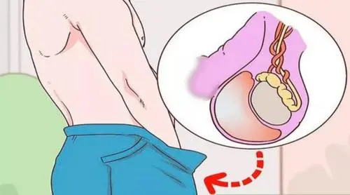 阴囊壁病变