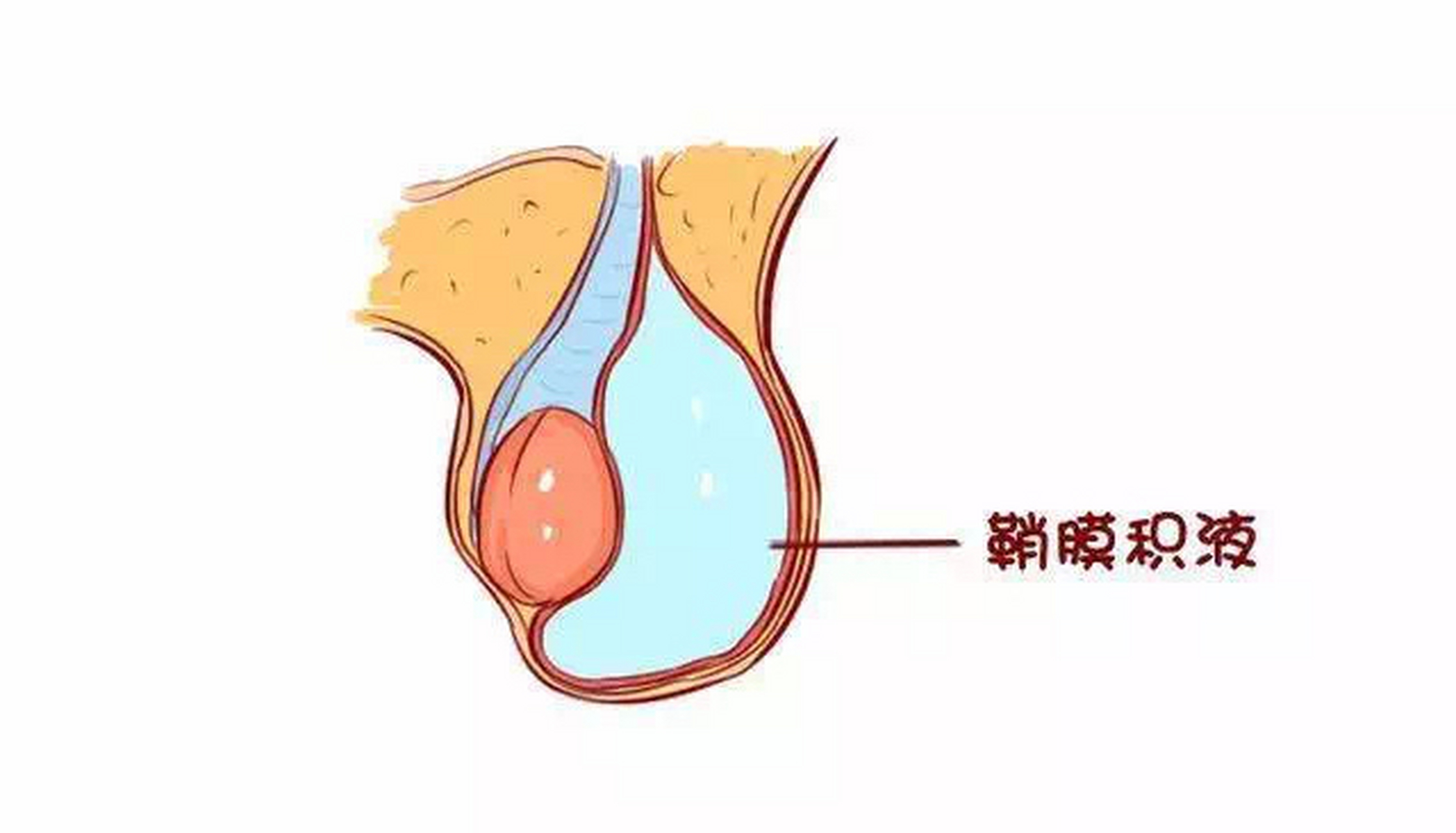 精索鞘膜积液