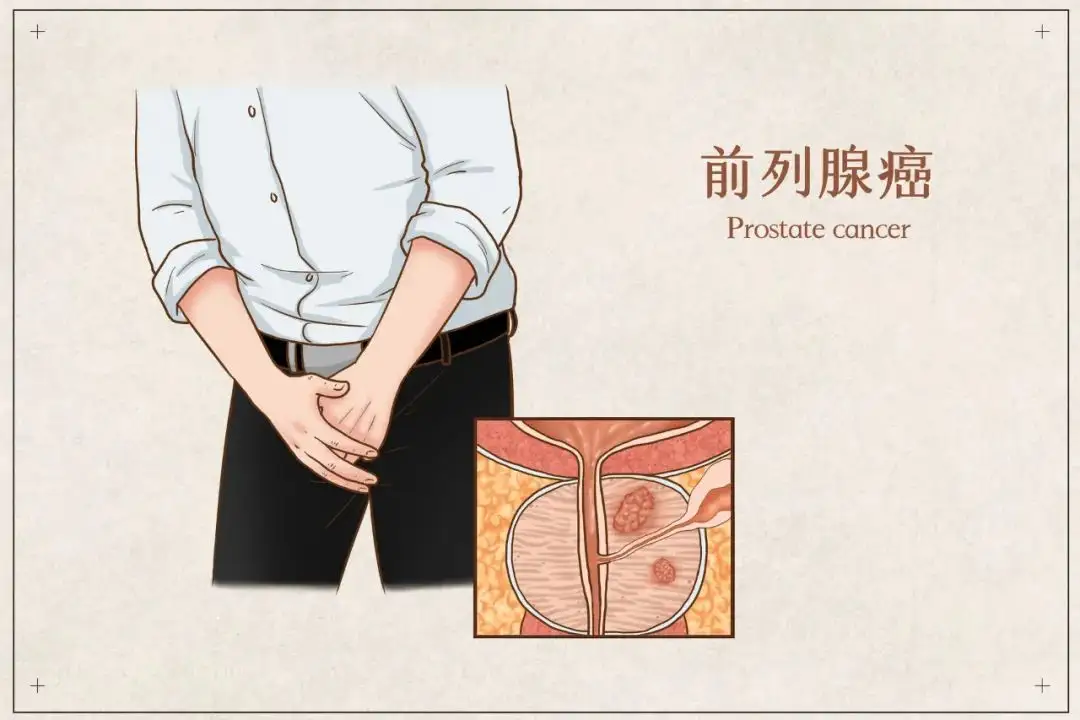 前列腺癌1