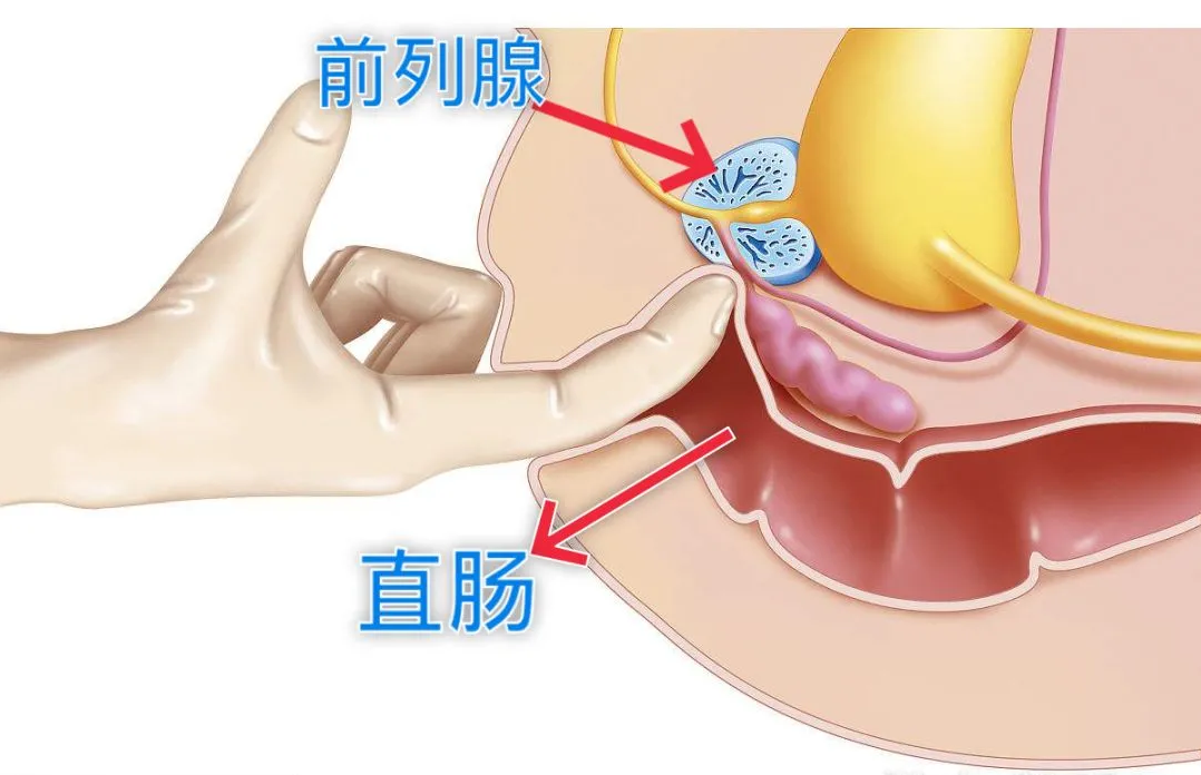 前列腺检查