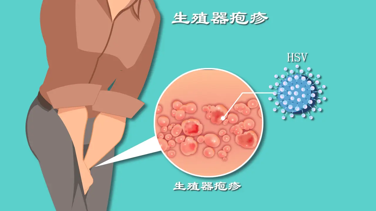 生殖器疱疹1