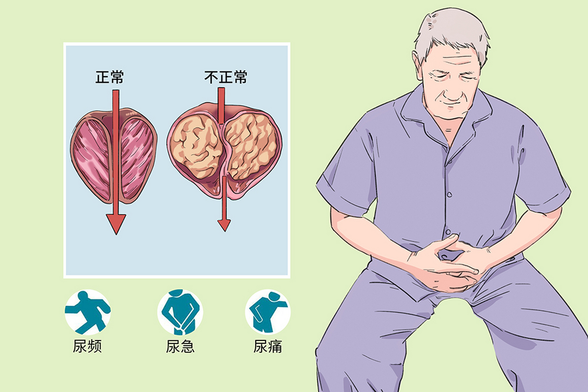 前列腺炎023