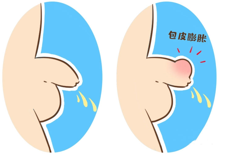 包皮排尿困难