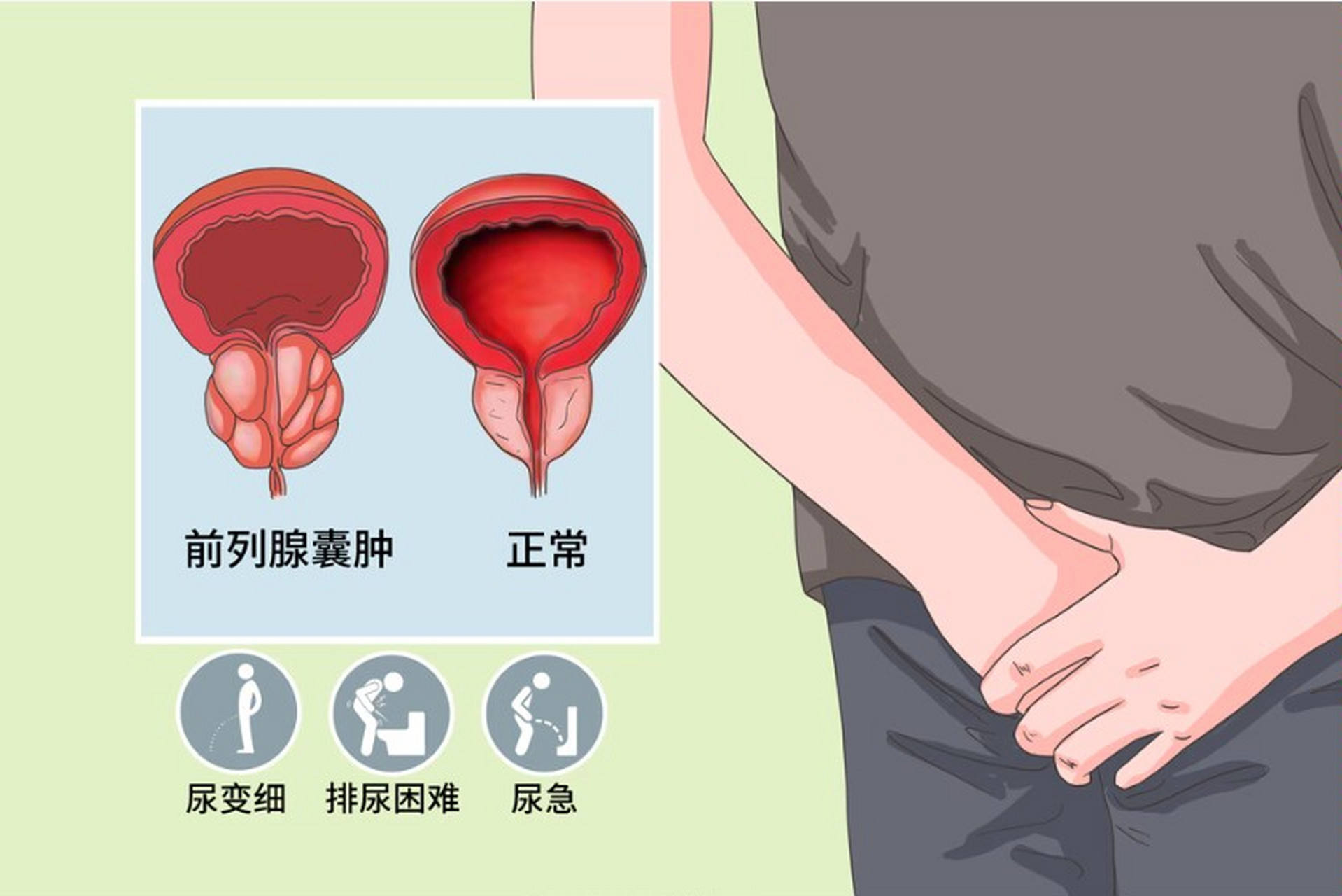 前列腺囊肿2