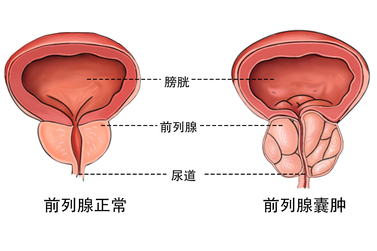 前列腺囊肿症状