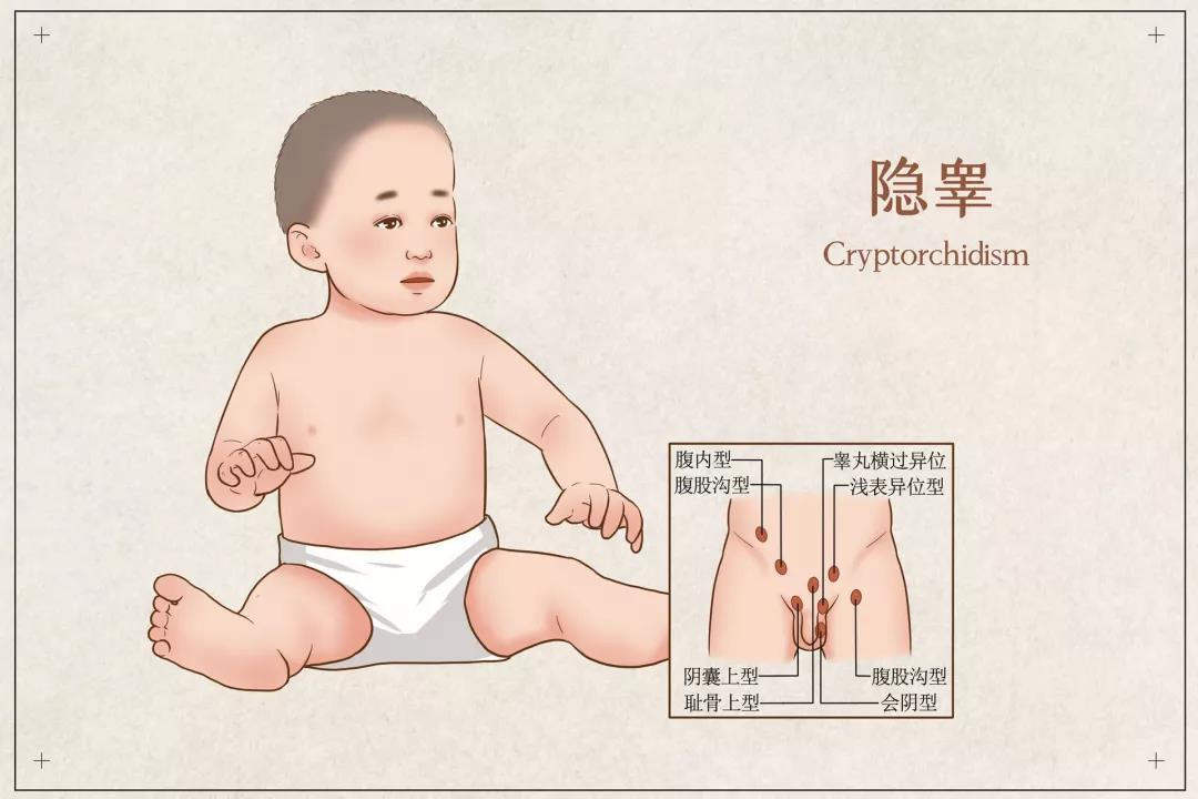 隐睾1