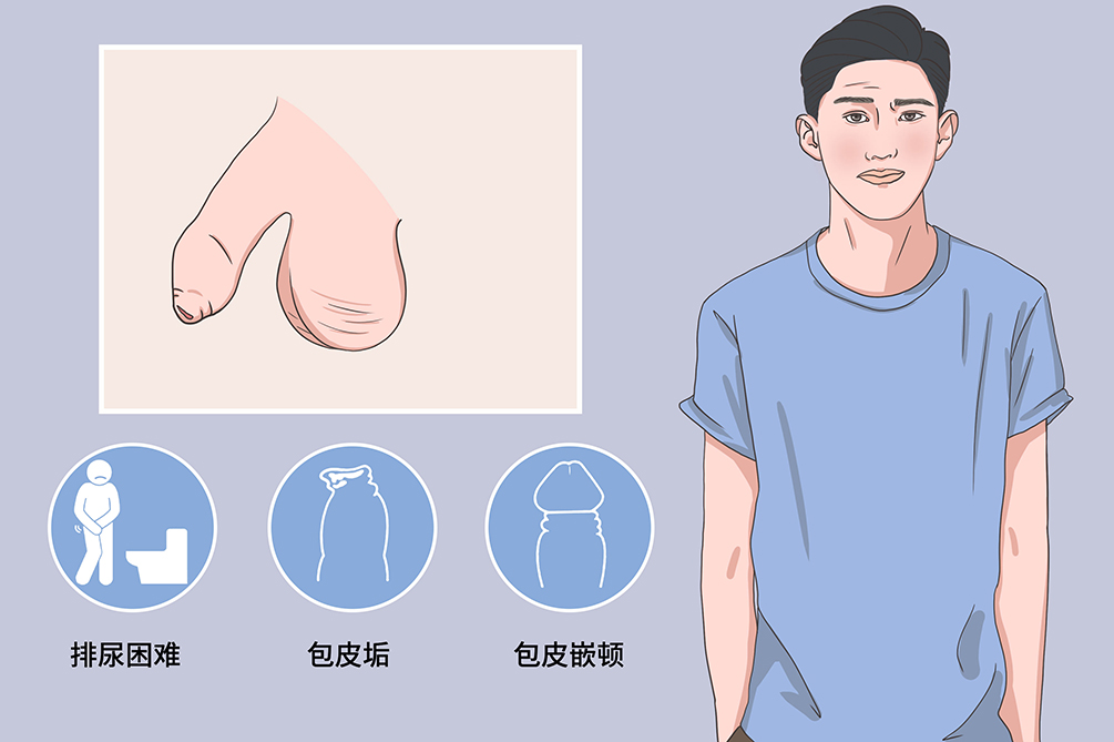 包皮过长2