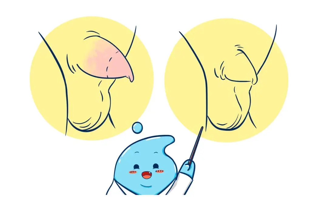 小儿包茎