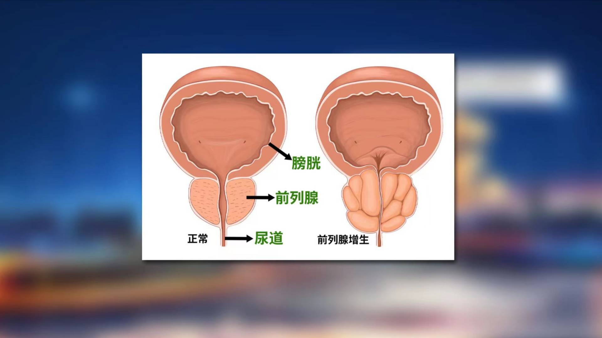 前列腺00