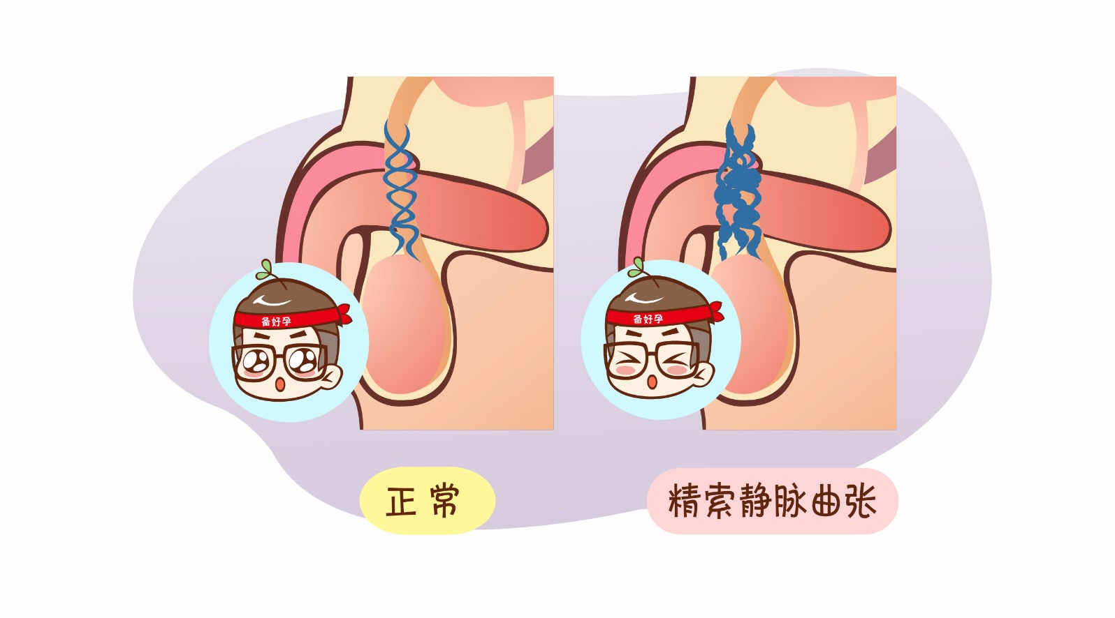 精索静脉曲张影响生育吗？