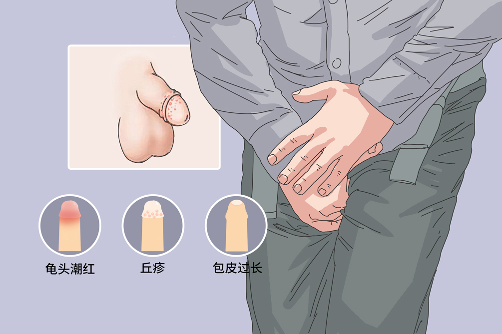 包皮过长