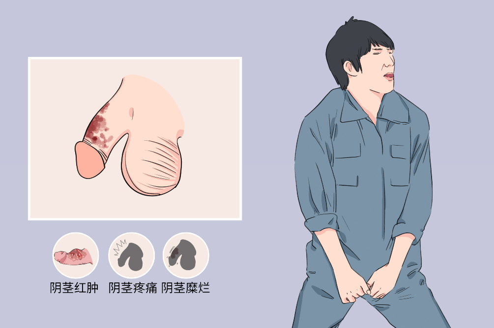 阴茎炎