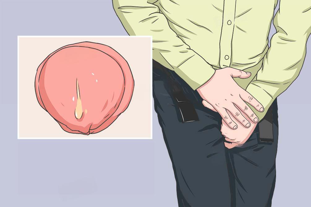 男性生殖疾病