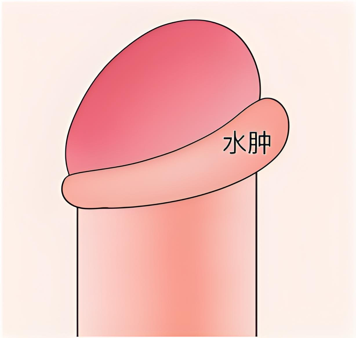 水肿