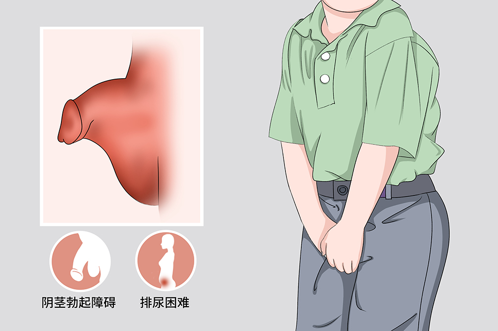 睾丸假两性畸形