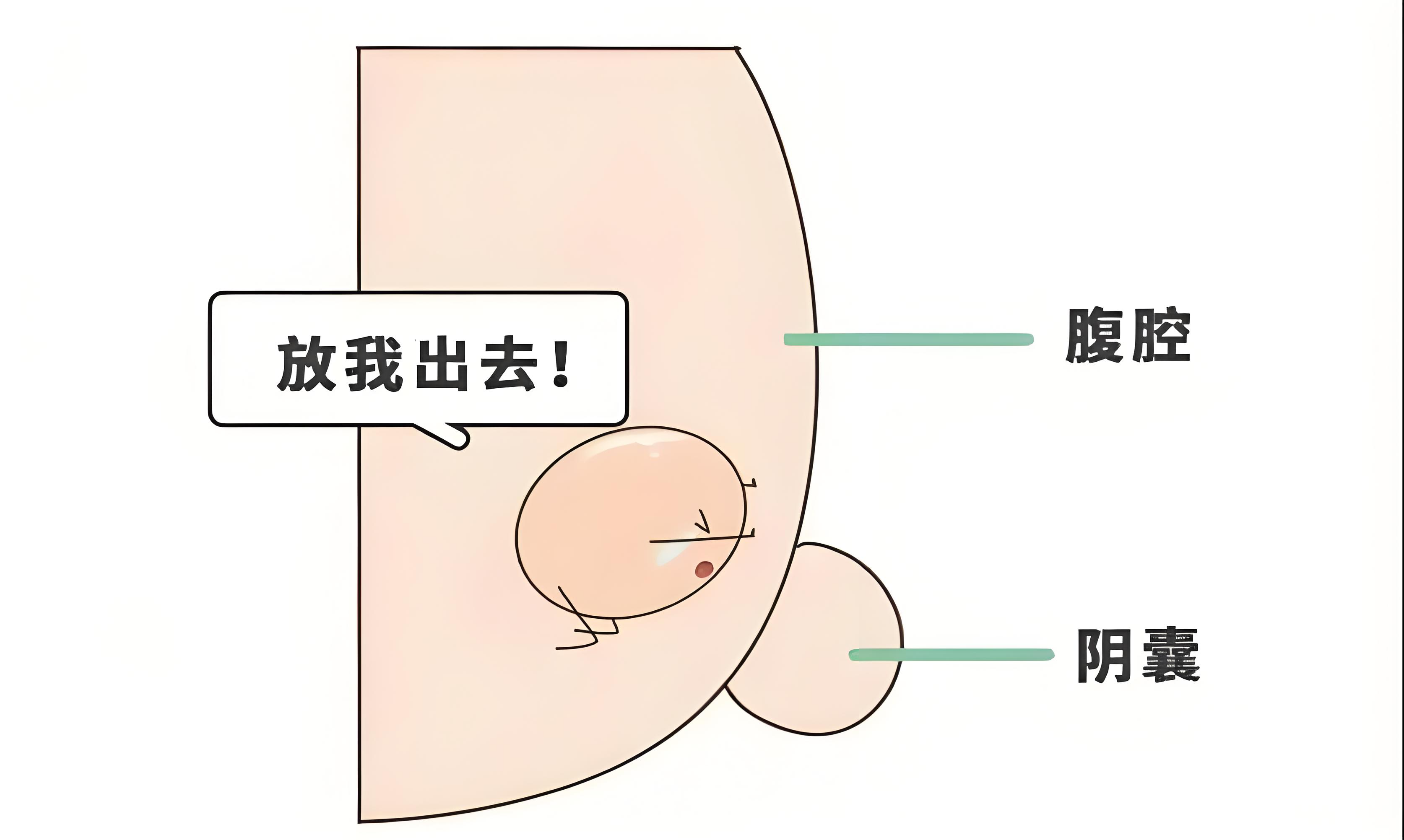 隐睾症