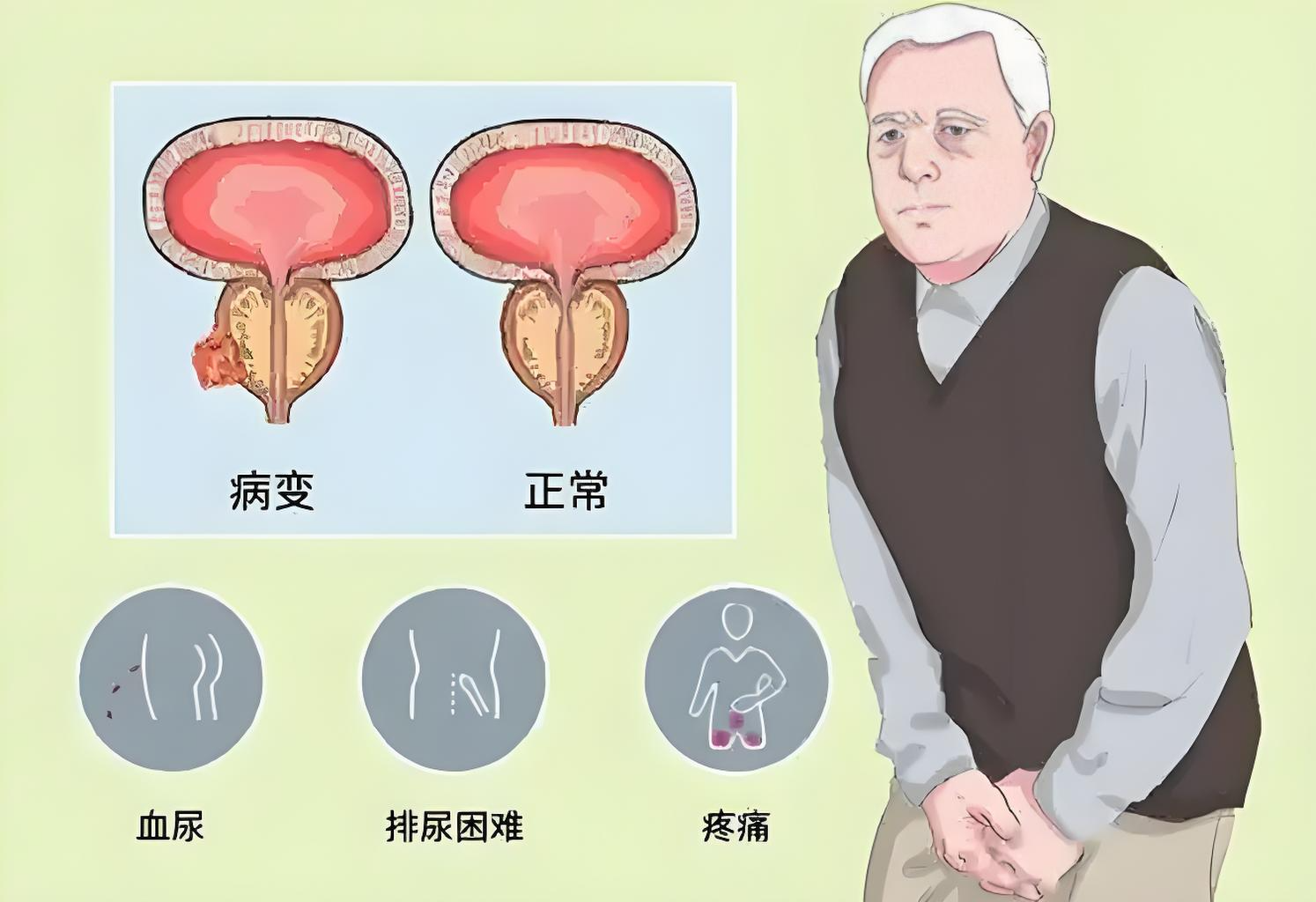 前列腺疾病