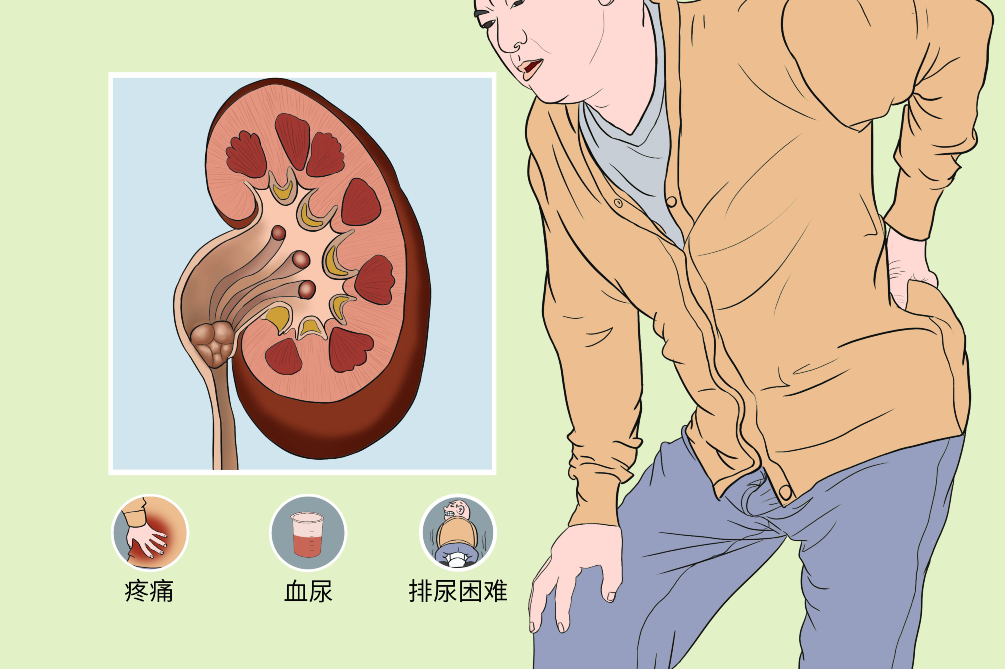 肾结石