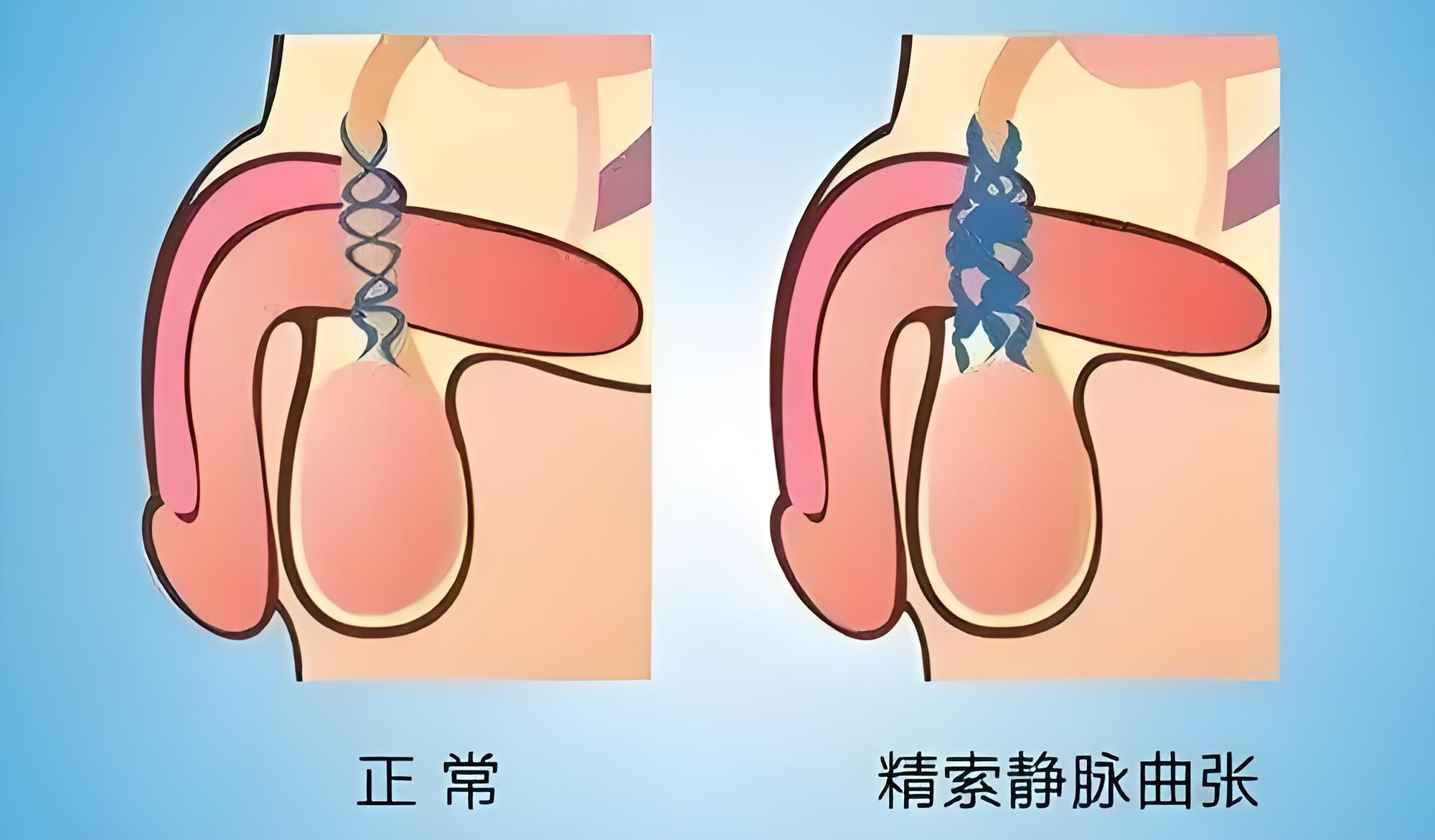 精索静脉曲张