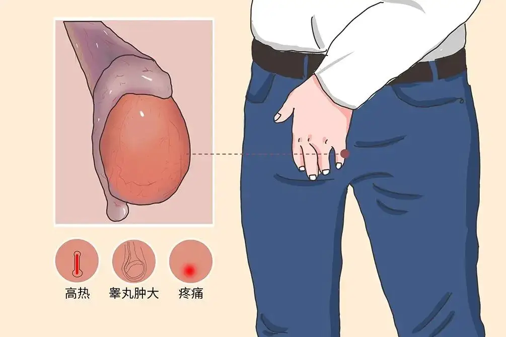 睾丸炎1 睾丸炎1