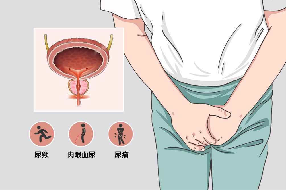 前列腺炎3