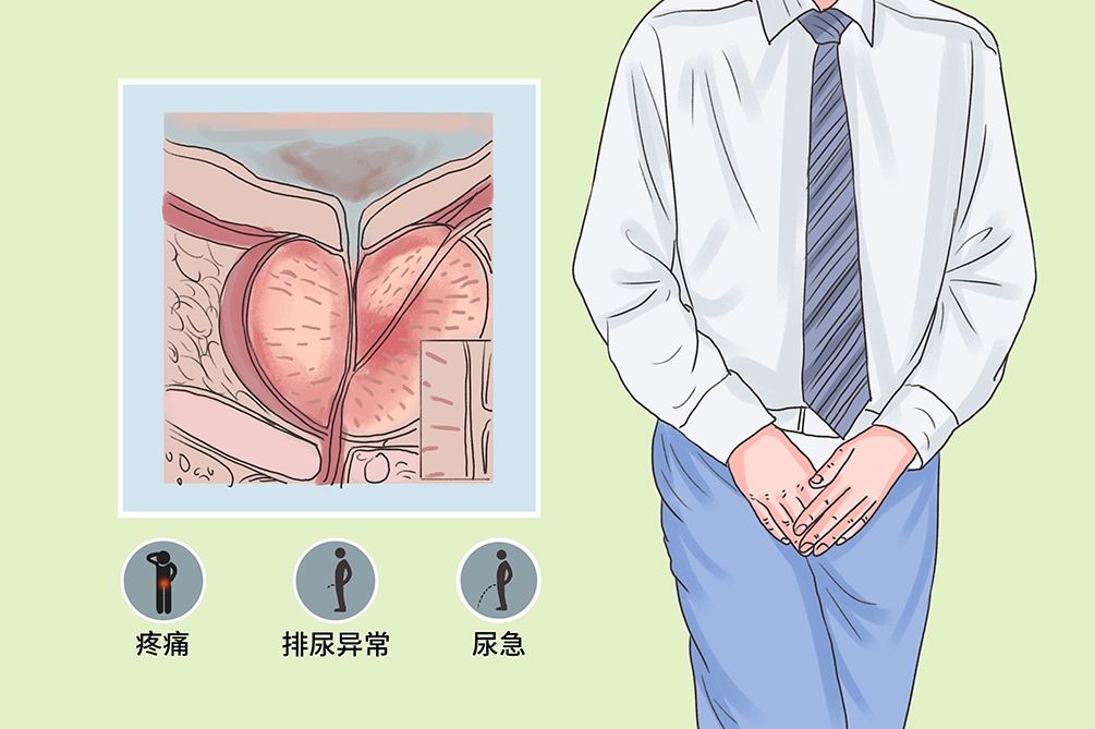 细菌性的前列腺炎