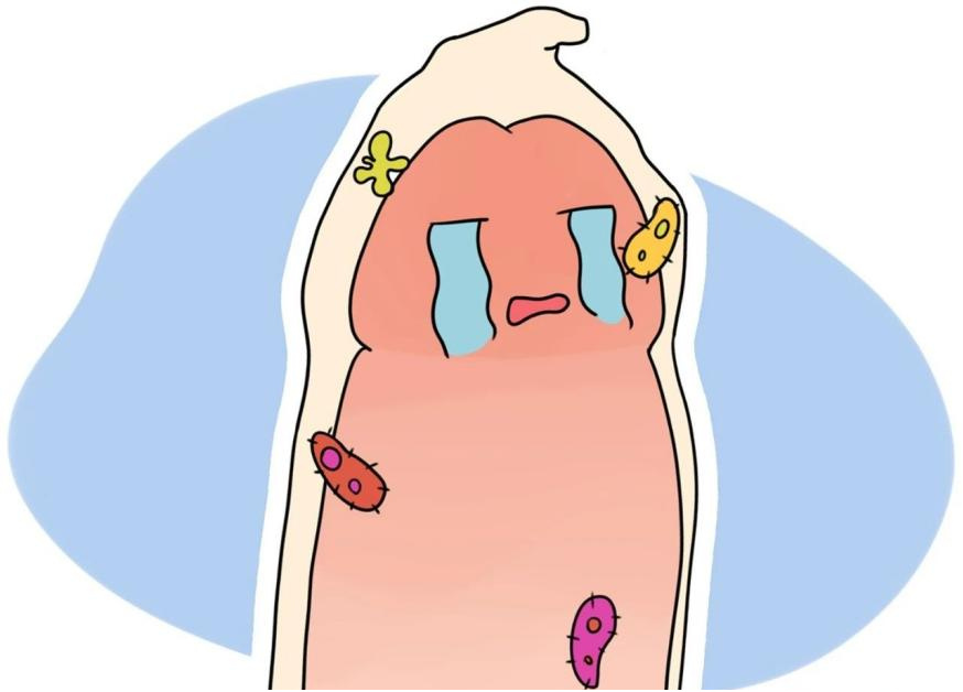 包皮龟头炎1 包皮龟头炎1